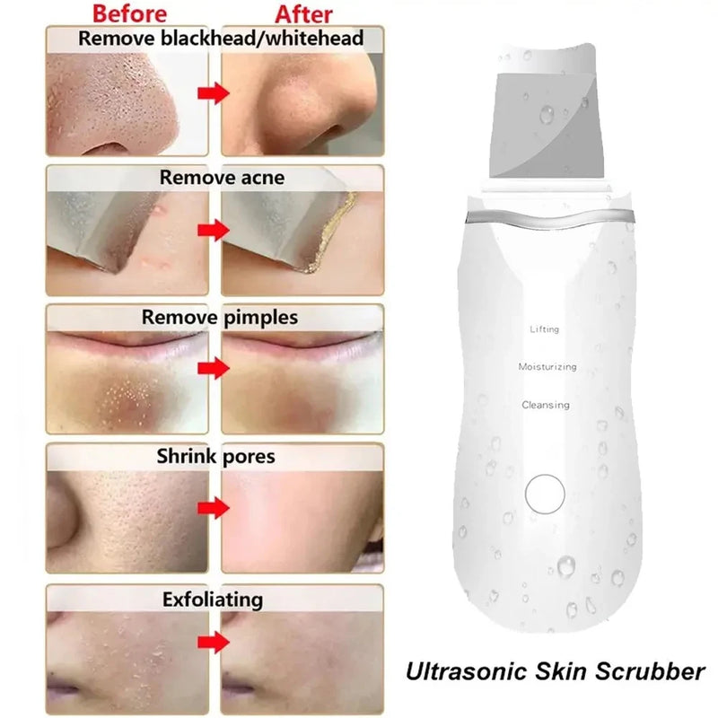 Esfoliador Facial Ultrassônico